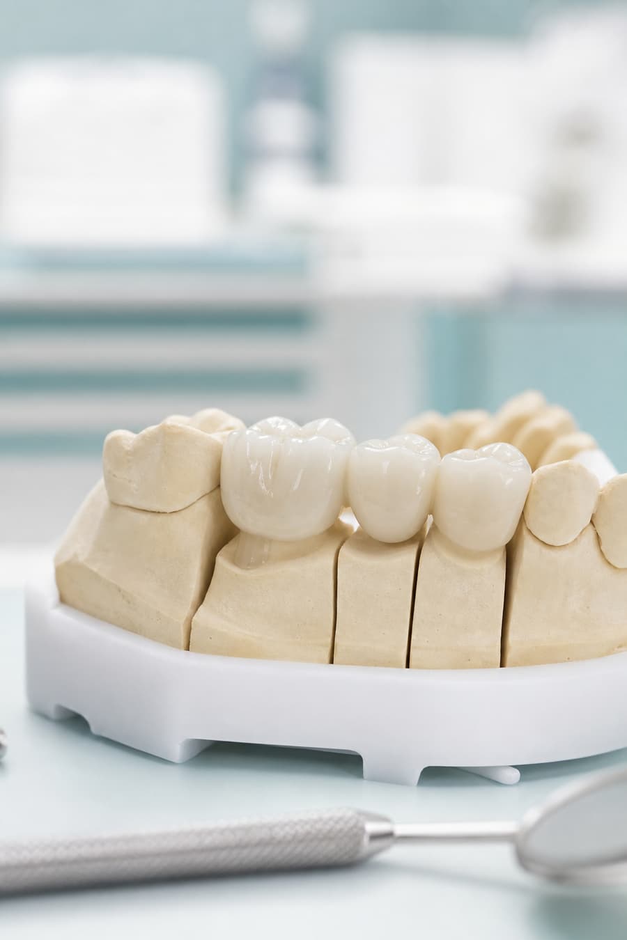 Ceramic dental crown and bridge on a tooth model