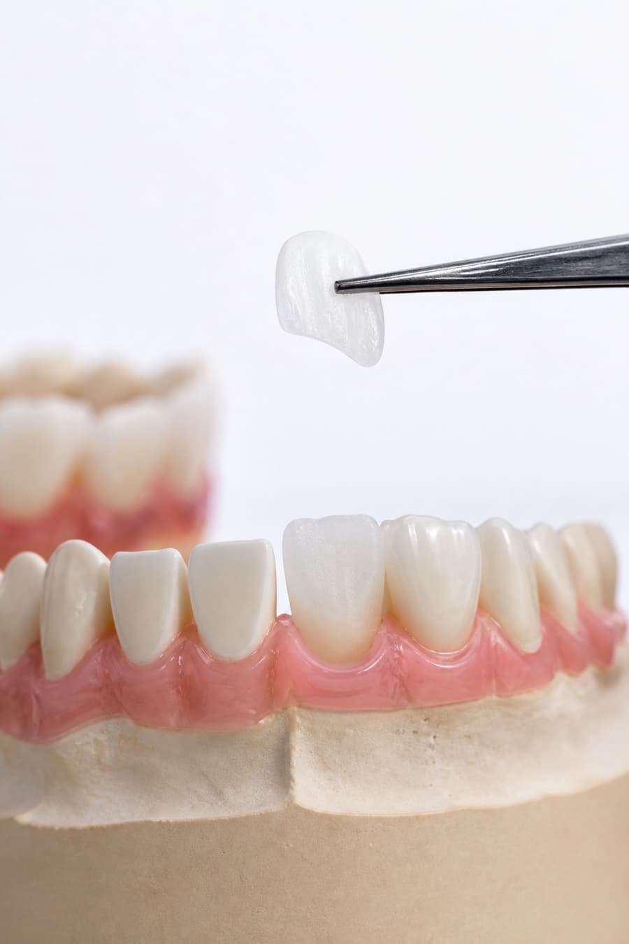 Porcelain dental veneer held above a dental model